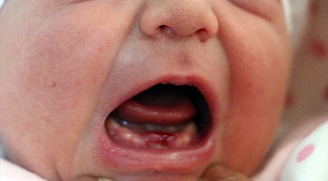 9 dişli bebek dünyaya geldi