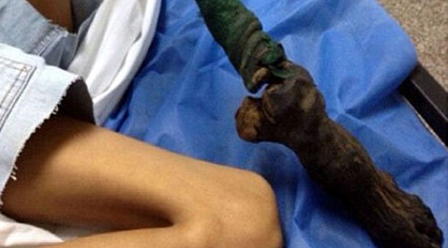 Yılan ısırığı bacağını çürüttü