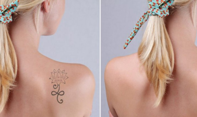 Lazerle Dövme Silme